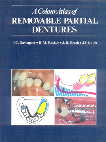 A Colour Atlas of Removable Partial Dentures by Jc Davenport ISBN 9780723416203