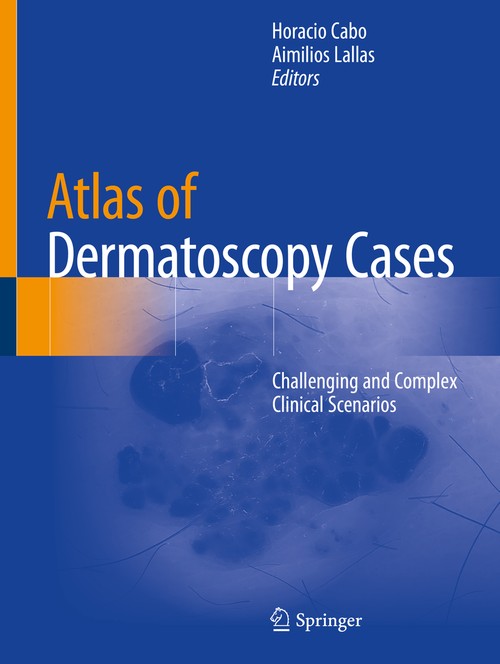 Atlas of Dermatoscopy Cases by Horacio Cabo ISBN 9783030436742