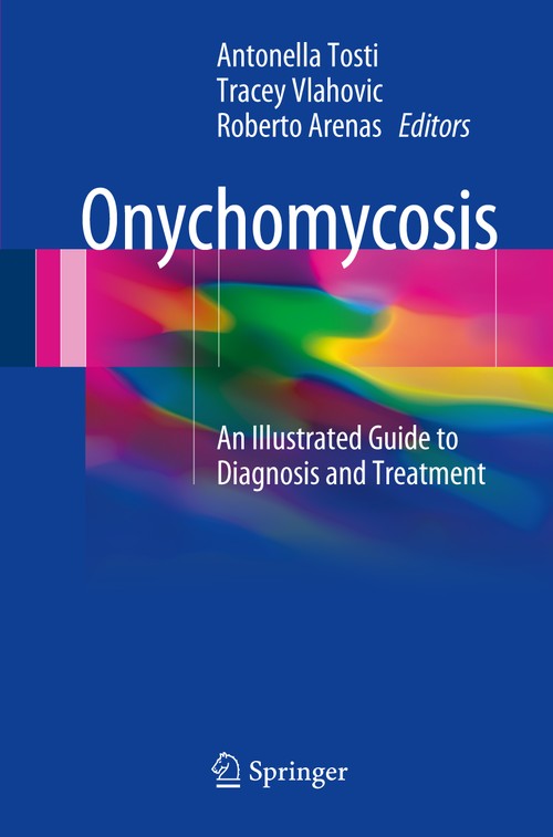 Onychomycosis by Antonella Tosti ISBN 9783319448527
