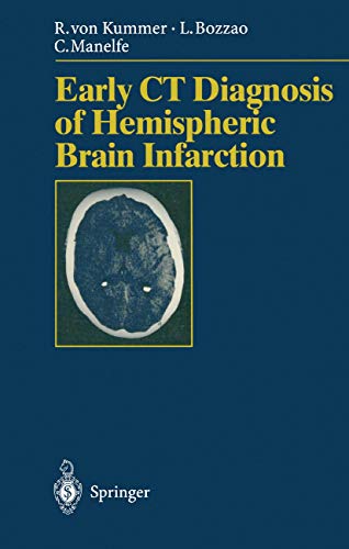 Early CT Diagnosis of Hemispheric Brain Infarction by S Bastianello | ISBN-13 9783540600565