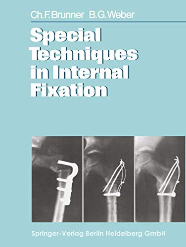 Special Techniques in Internal Fixation by C F Brunner | ISBN-13 9783662023471